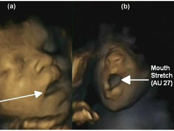 Bebê boceja no ultrassom